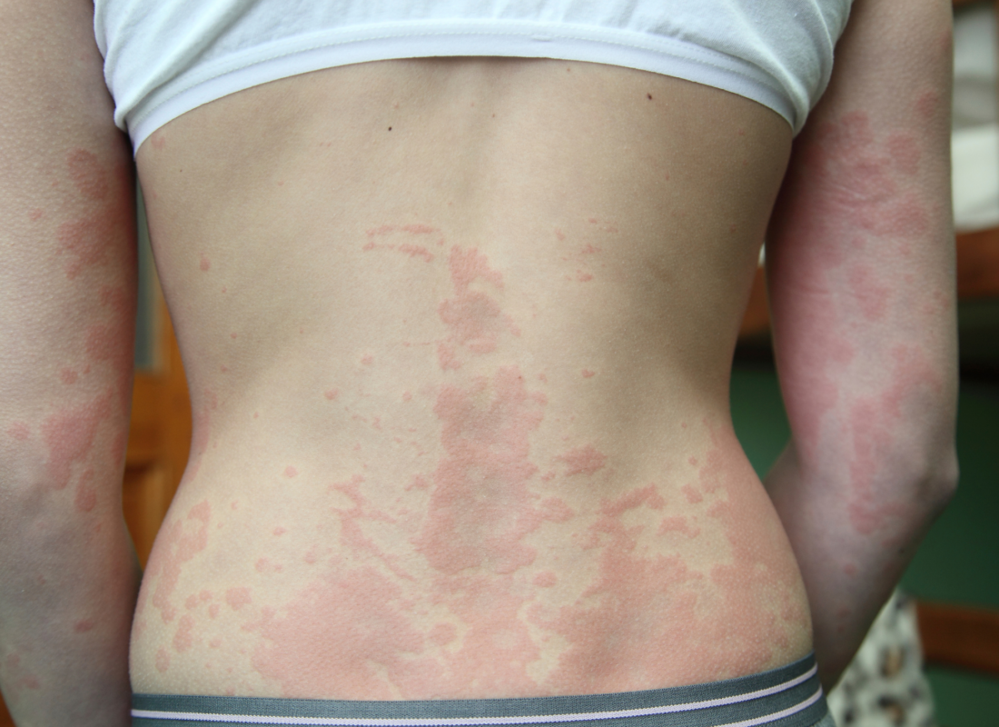 Are You Allergic To Your Underwear? (Symptoms, Causes, & Solutions