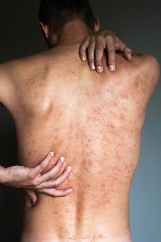 Your Guide to Clothing Dermatitis: Nylon, Nickel, Latex, & More - The ...